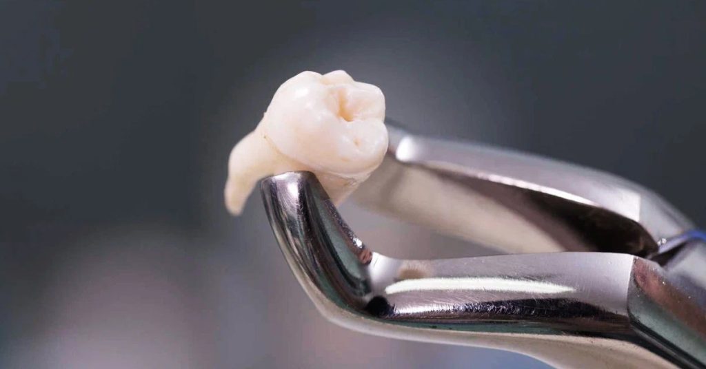 Как происходит процедура удаления зубов мудрости?